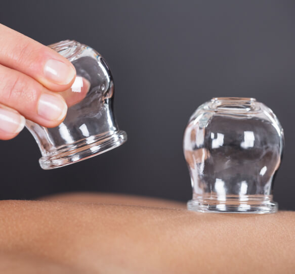 Cupping therapy treatment